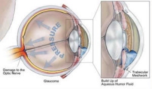 Glaucomaproductieoogvocht